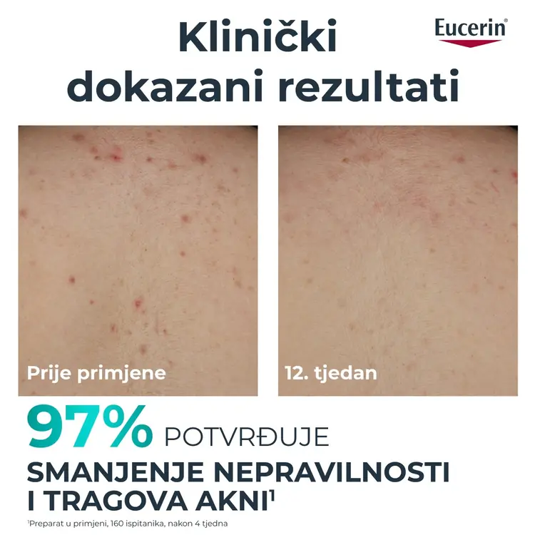 Eucerin DermoPure Clinical losion za tijelo s trostrukim djelovanjem, 200 ml