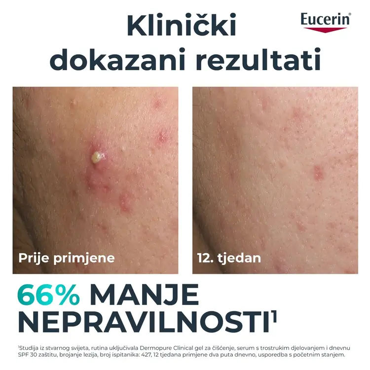 Eucerin DermoPure Clinical serum s trostrukim djelovanjem, 40 ml