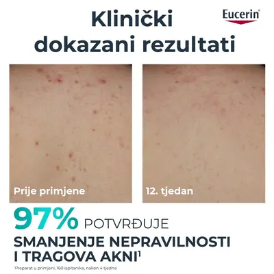 Eucerin DermoPure Clinical losion za tijelo s trostrukim djelovanjem, 200 ml